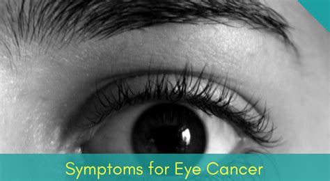 4 Categories And Symptoms Of Eye Cancer You Must Know