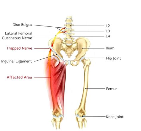 Pinched Nerve In The Hip Injury Medical Chiropractor
