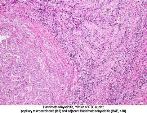 Pathology Outlines Hashimoto Thyroiditis