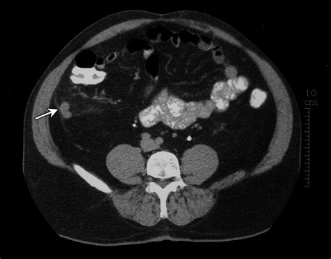 Why We Miss The Diagnosis Of Appendicitis On Abdominal Ct Evaluation