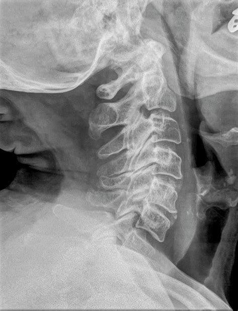 Cervical Spine X Ray Ladegseven
