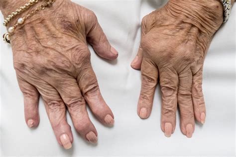 Early Treatment Counters Joint Damage From Rheumatoid Arthritis