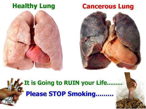 Healthy And Cancerous Lung Smoking Is Bad For You Pinterest