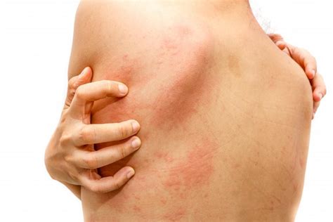 Hives In Adults Causes