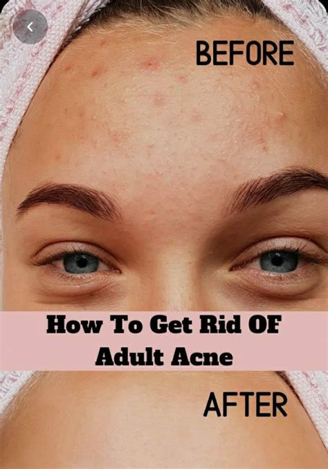Pin On Acne Scars