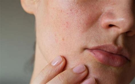 How To Deal With Hole In Skin After Pimple Popping