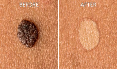 How To Get Rid Of Moles 9 Natural Home Remedies To Remove Moles From