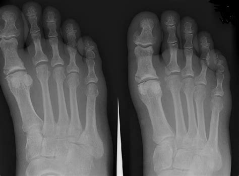 A Broken Toe Guide 2018 Update Medical Experts