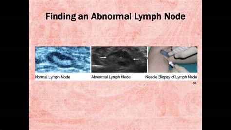Lymph Node Mapping Role Of Sonography Youtube