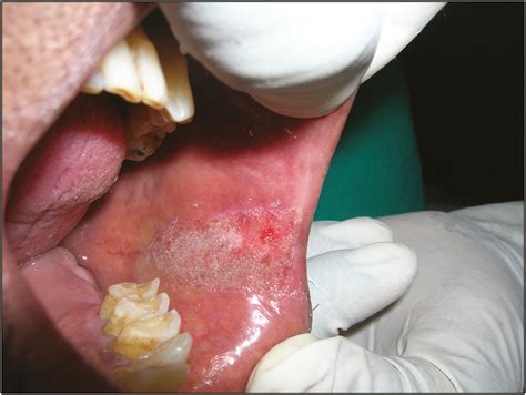 Oral Candidal Leukoplakia Treated With Co2 Laser Mechery R Arora P