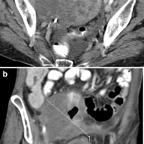 A Computed Tomography Scan At Diagnosis Showing The Pelvic Mass