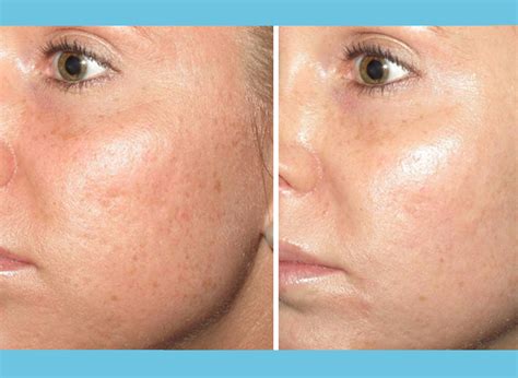 microneedling_before_after_blog1 - Denver Skin Care