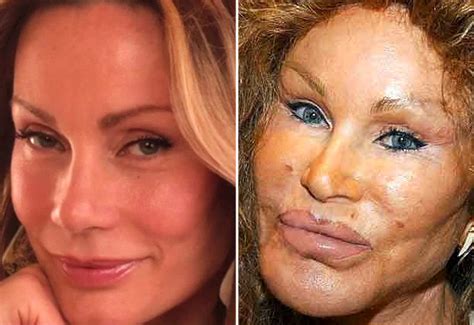 Check spelling or type a new query. Los antes y después de las celebridades tras el botox ...