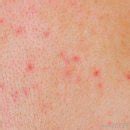Especially if you haven't seen shingles pictures, you could easily the shingles virus causes an outbreak of a red rash and blisters across the face and body, like many other skin. Spinal Meningitis Pictures