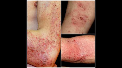 Dermatitis Causas Y Remedios Naturales Hot Sex Picture