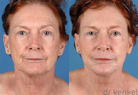Facial Rejuvenation Before And After Pictures Case 53 Dallas Frisco Mckinney Prosper Allen