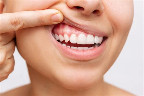 How To Improve Your Gums Thoughtit20