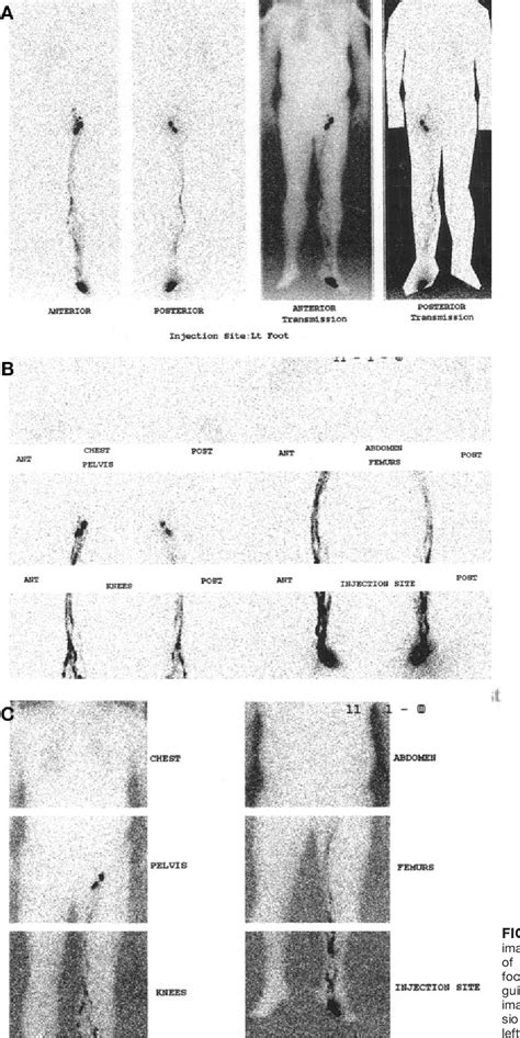 Figure 1 From Whole Body Lymphoscintigraphy Using Transmission Scans