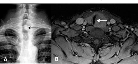 Figure 4 From Ct And Mr Imaging Of Thyroid Carcinoma Showing Thymus