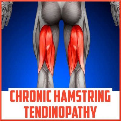 Chronic Hamstring Tendinopathy A Review Sports Medicine Review