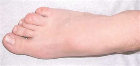 Figure 1 From Vascular Anomalies Birthmarks Of The Foot And Ankle
