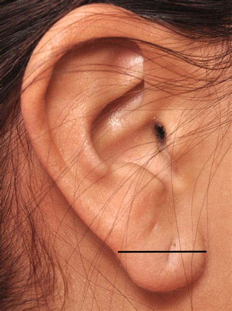Plastic Surgery Case Study Earlobe Reduction Of Caudal Ptosis In