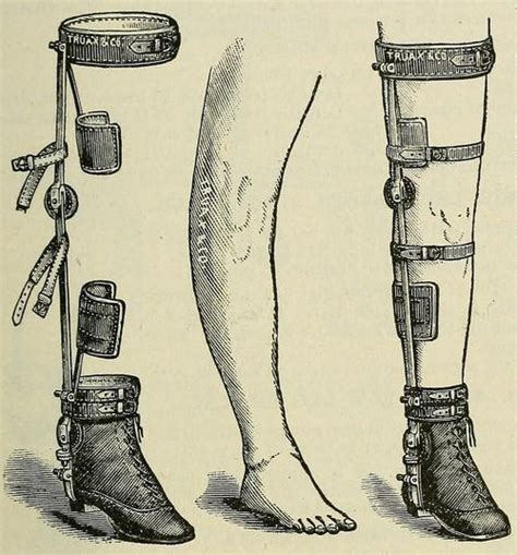 Deformity Apparatus Chas F Stillmans Long Bow Leg Braces 1893
