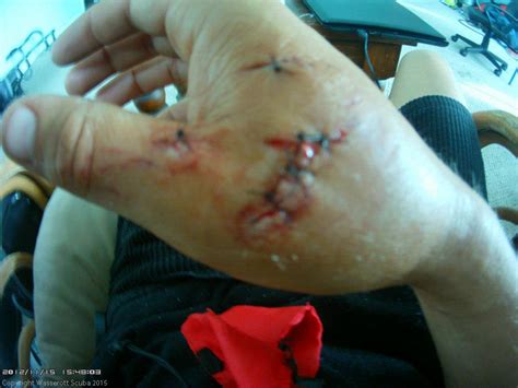 They belong to a family of elongated bony fishes with an impressive dental battery (muraenidae), and my right hand has distinct impressions to. Ouch: An Eel Bite Is 'Like a Knife' Cutting Into You