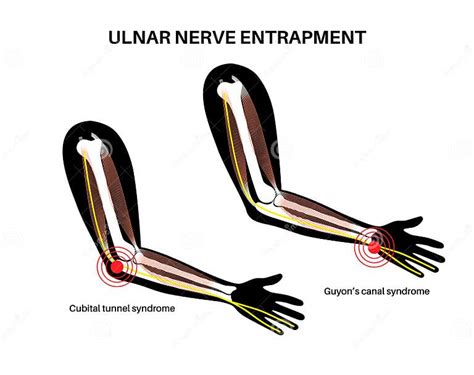 Ulnar Nerve Entrapment Stock Illustration Illustration Of Disease