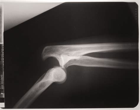 X Ray With Dislocated Arm Joints Copyright Free Photo By M Vorel