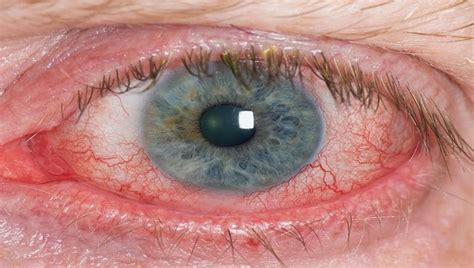 Using computer for prolonged time led to the users at greater health risk of computer vision syndrome (cvs). DRY EYE SYNDROME - EHC (Eye Health Clinic) - Voted Top 10 ...