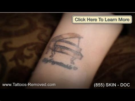 For more information, call us today. Best Laser Tattoo Removal in New York NY | Laser Tattoo ...