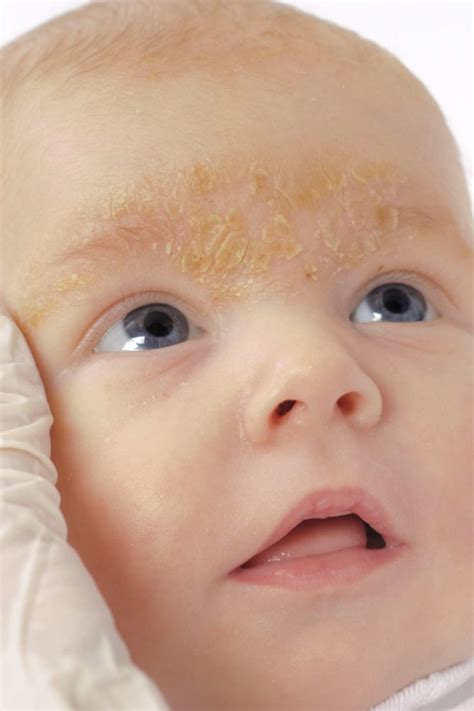Baby Rash On Face
