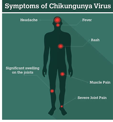 What Is Chikungunya Prevention And Treatment Of The Virus
