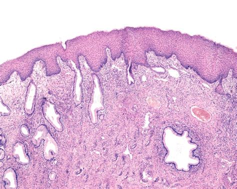 Endocervix Humano Metaplasia Escamosa Foto De Archivo Imagen De