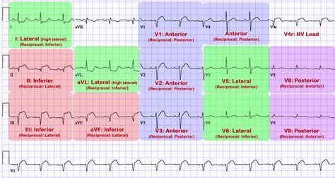 St Elevation Mi Stemi What You Need To Know The Operating Room