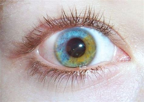 Sectoral Heterochromia Blue And Green