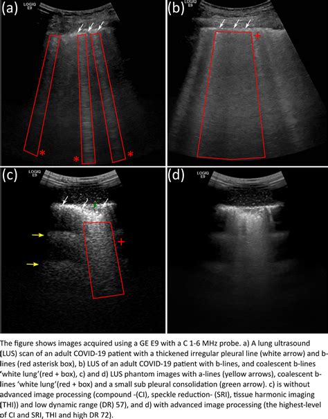 Establishing Lung Ultrasound As A Key Tool In The Stratification And