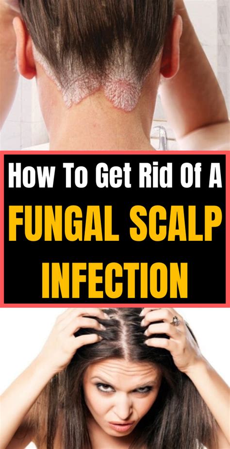 How To Get Rid Of A Fungal Scalp Infection Passionofswathi