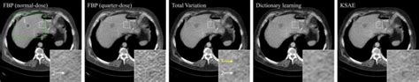 Iterative Low Dose CT Reconstruction With Priors Trained By Artificial