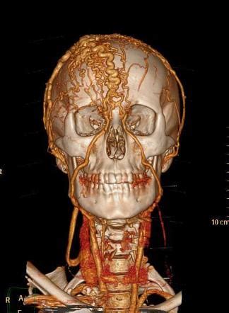 Giant Scalp Arteriovenous Malformation Radiology Case Radiopaedia Org
