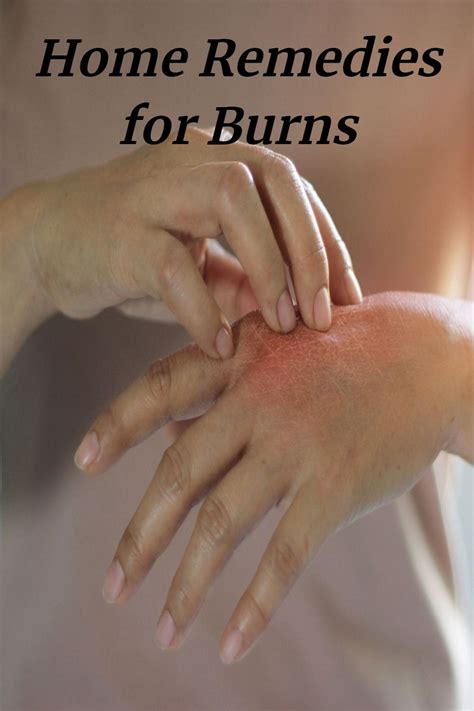 Home Remedies For Burns Home Remedies For Burns How To Heal Burns