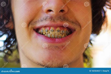 Portrait Of Young Handsome Man With Braces Stock Image Image Of Park Nature 182564657