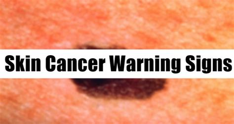 Skin Cancer Warning Signs Indications That You Might Have Skin Cancer