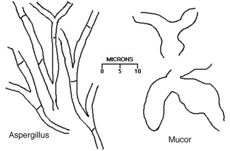 The disease is often characterized by hyphae growing in and around blood vessels and can be potentially. Pulmonary Pathology