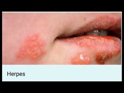 Are pimples on buttocks a sign of herpes, hiv or other stds? Naturally Cure Herpes@ - YouTube
