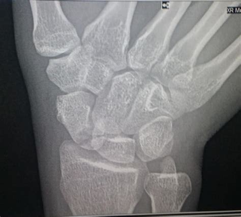Scaphoid Fracture Orthobullets My XXX Hot Girl