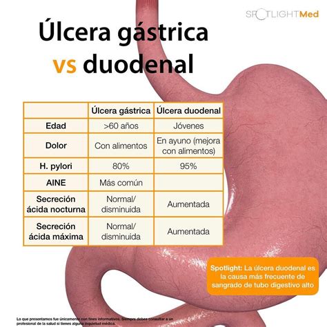 Diferencia Entre Ulcera Gastrica Y Ulcera Duodenal Kofi