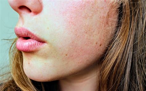 Could Dry Skin Be Related To Your Hormones Pro Pell Therapy Program