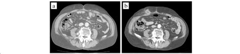An Abdominal Contrast Enhanced Computed Tomography Ct A Two Months